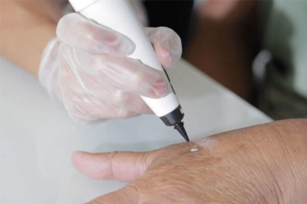 CryoPen